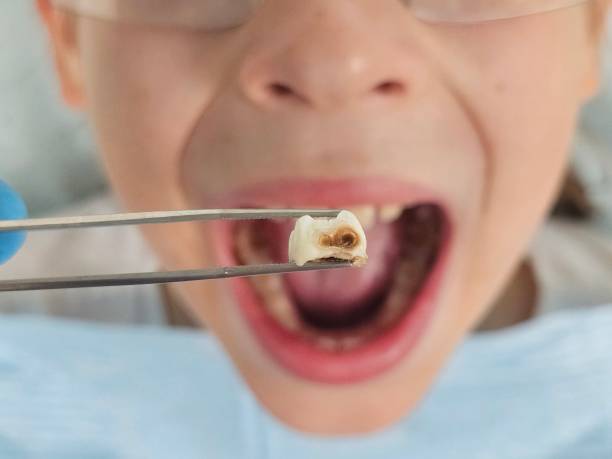 Best Chipped Tooth Repair Near Me  in Floydada, TX